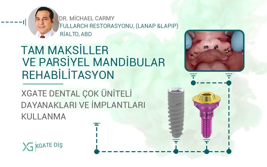 XGATE Dental Çok Üniteli Abutmentler ve İmplantlar Kullanılarak Tam Üst Çene ve Kısmi Alt Çene Rehabilitasyonu
