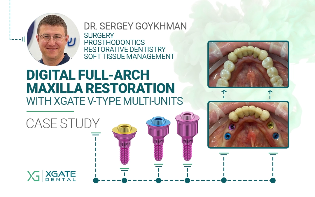 Çıkarılabilir Protezin Kalıcı İmplant Destekli Restorasyonla Değiştirilmesi: MUA V-Type XGATE Dental’de Vida Tutuculu Sistem