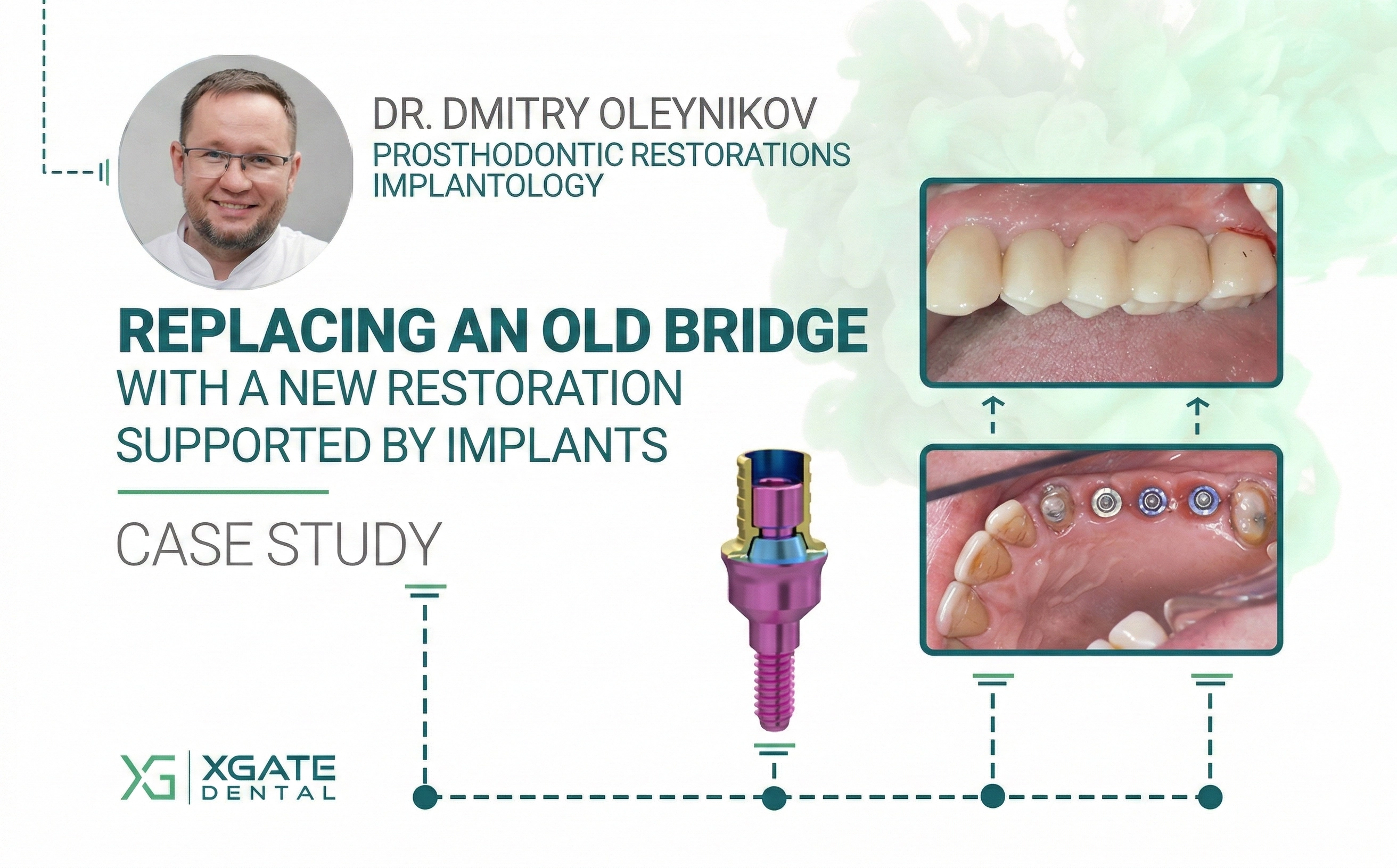 Eski bir köprünün, implantlar ve XGATE Dental V-Tipi abutmentlerle desteklenen yeni bir restorasyonla değiştirilmesi.
