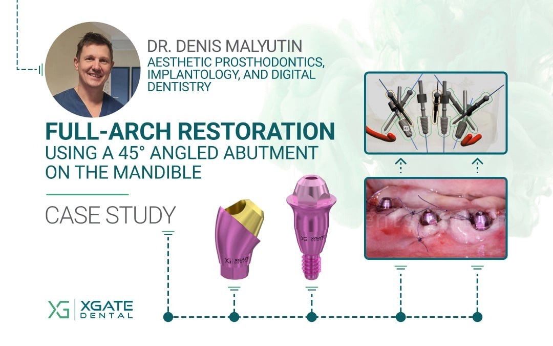Tam Ark Restorasyonu İçin Alt Çenede 45° Açılı Abutment Kullanımı